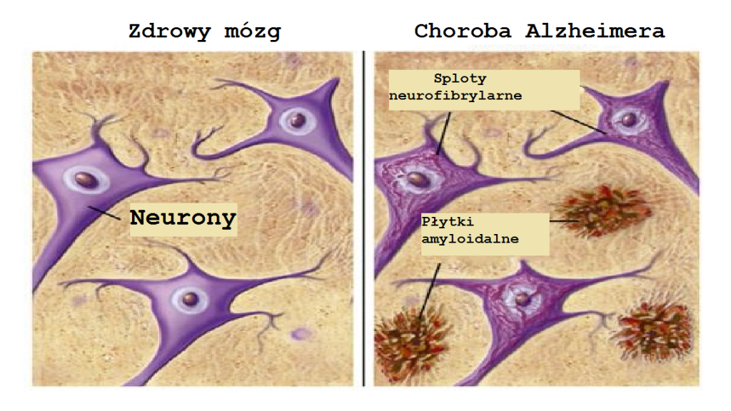 Choroba Alzheimera Jak Jej Zapobiegać Krok Do Zdrowia 0275