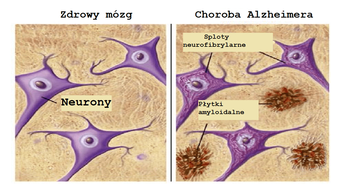 Neurony i Alzheimer