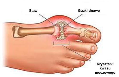 Dna moczanowa