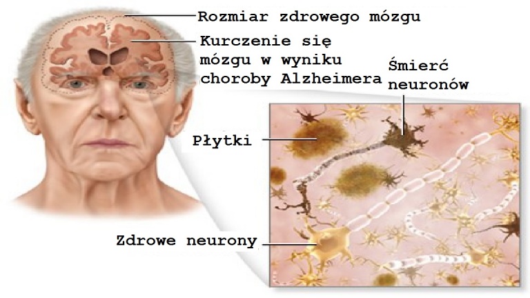 Choroba Alzheimera – jak jej zapobiegać?