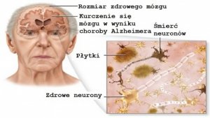 Choroba Alzheimera – jak jej zapobiegać?