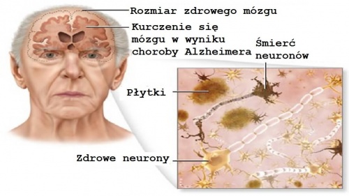Choroba Alzheimera Jak Jej Zapobiegać Krok Do Zdrowia 3624