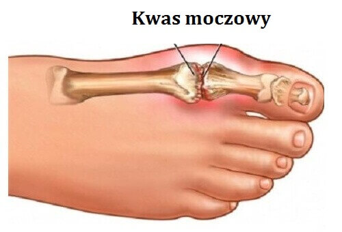 karczochy na kwas moczowy
