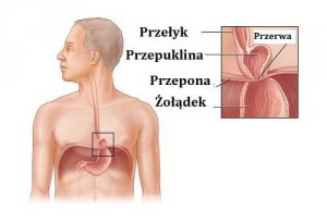 Przepuklina rozworu przełykowego - Jak ją leczyć?