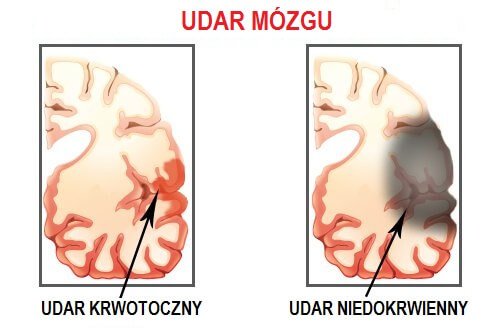 Udar mózgu