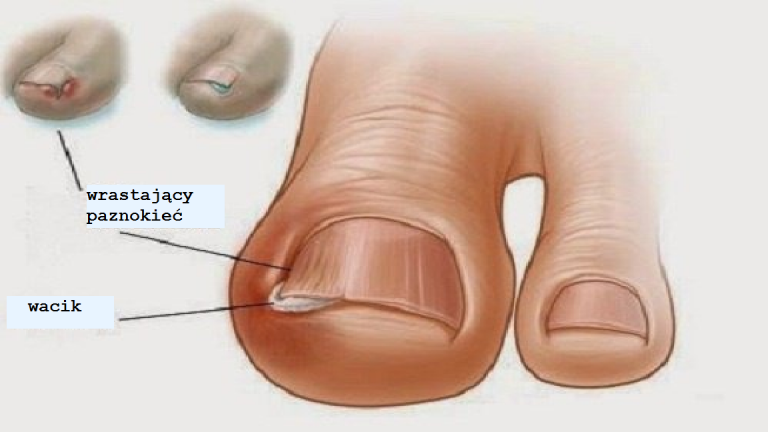 Wrastające paznokcie – domowe leczenie