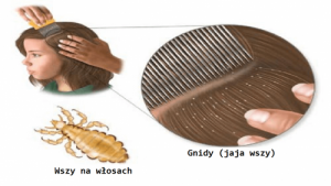 Usuwamy wszy – 5 domowych sposobów