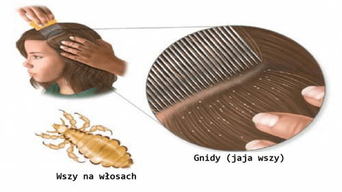 Usuwamy wszy – 5 domowych sposobów Usuwamy wszy – 5 domowych sposobów