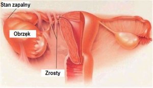 Zapalenie narządów miednicy mniejszej - symptomy