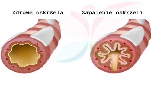 Zapalenie oskrzeli