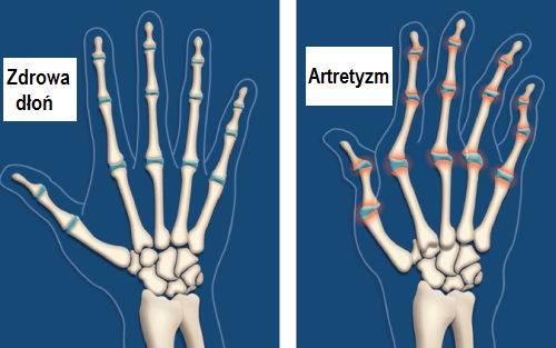 Artretyzm w dłoniach