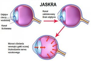Jaskra - czym jest i jak ją leczyć?