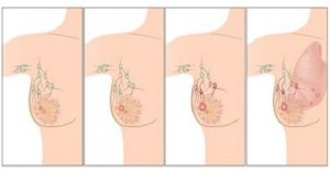 Rak piersi – poznaj jego przyczyny