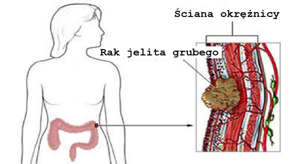 rozwój-raka-jelita-grubego.jpg Rozwój raka jelita grubego u kobiet