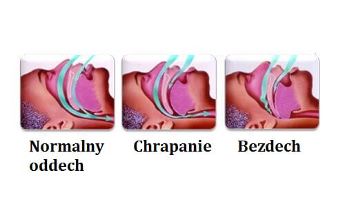 Chrapanie