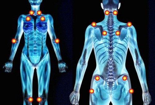 fibromialgia.jpg Fibromialgia