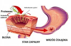 Bakteria Helicobacter pylori – jak ją zwalczyć?