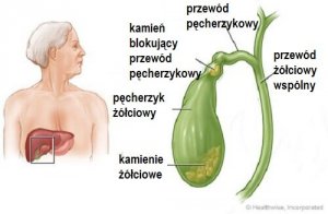 Kamienie żółciowe - naturalne sposoby