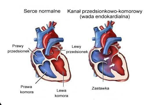 Szmery w sercu: 7 objawów, na jakie zwróć uwagę