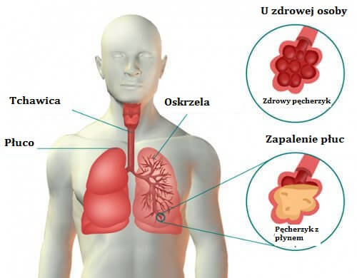 Zapalenie płuc - objawy i leczenie