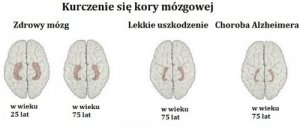 Alzheimer - rozpoznaj wczesne sygnały