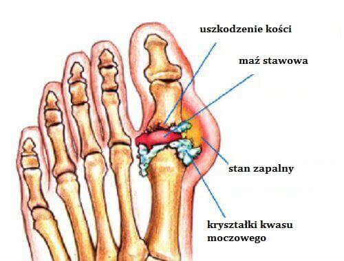 Schemat dny moczanowej