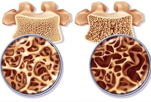 osteoporoza Osteoporoza