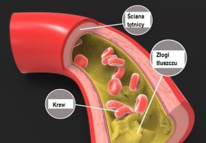 Triglicerydy - jak obniżyć ich poziom?
