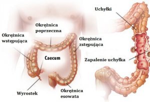 Jelita - uchyłkowatość i zapalenie uchyłka