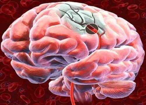 Udar mózgu - jak rozpoznać symptomy?