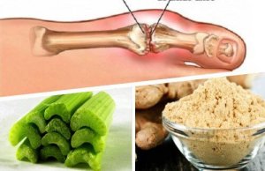 Nadmiar kwasu moczowego? – Naturalne remedium