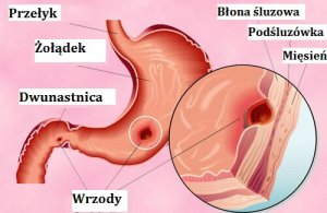 Wrzody żołądka - Naturalne lekarstwa