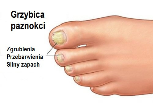 olejek pomarańczowy na grzybicę paznokci