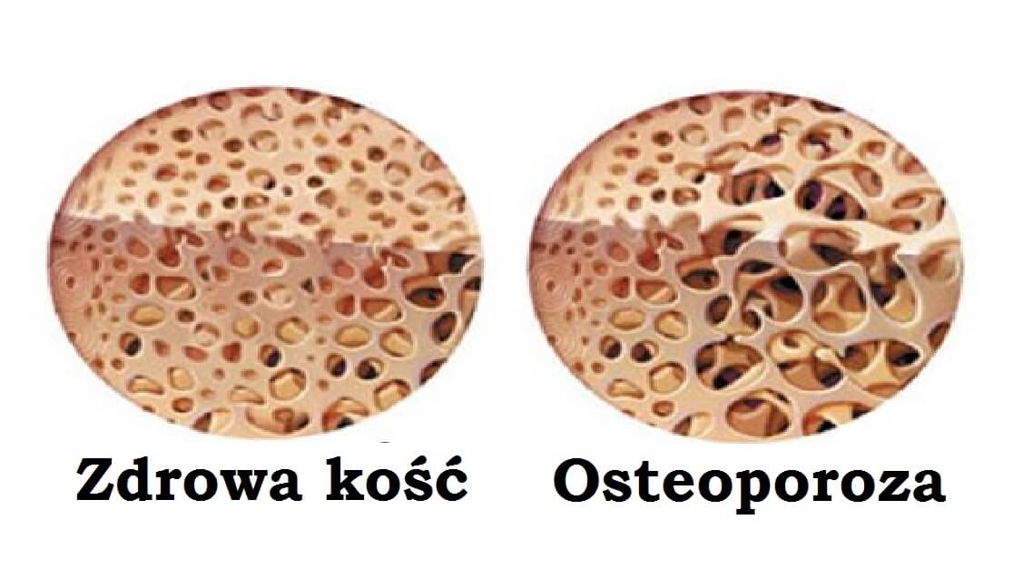 Kości a osteoporoza