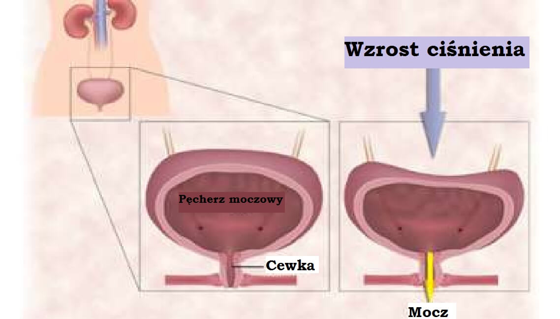 Nietrzymanie moczu - schemat