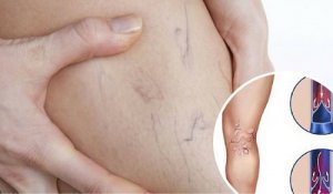 Pajączki i żylaki - mniej widoczne dzięki ziołom