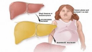 Stłuszczenie wątroby - pomocne owoce