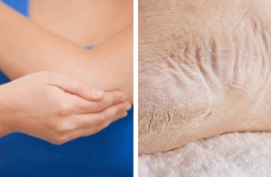 Suche łokcie i pięty – wylecz je w tydzień!