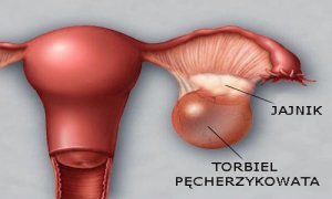 Torbiel jajnika - profilaktyka i wykrywanie