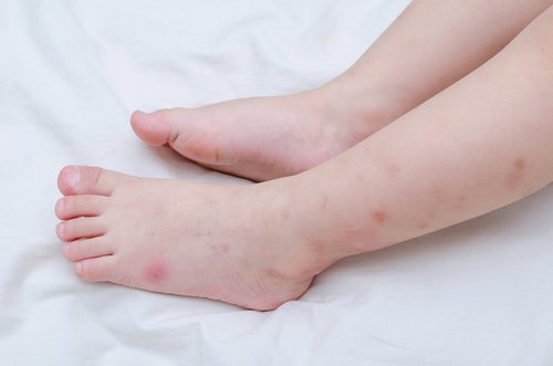 Ukąszenie przez komary na nogach