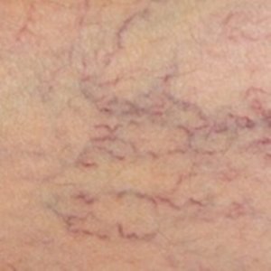 Żylaki - Naturalne sposoby leczenia