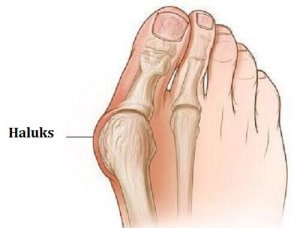 Haluksy - Jak im zapobiec?