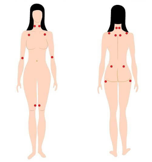 Objawy fibromialgii