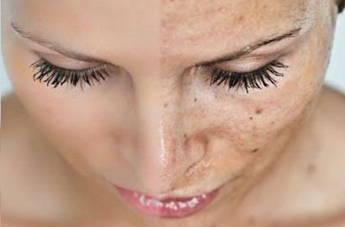 Przebarwienia skórne