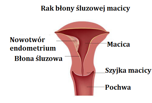 Rak endometrium