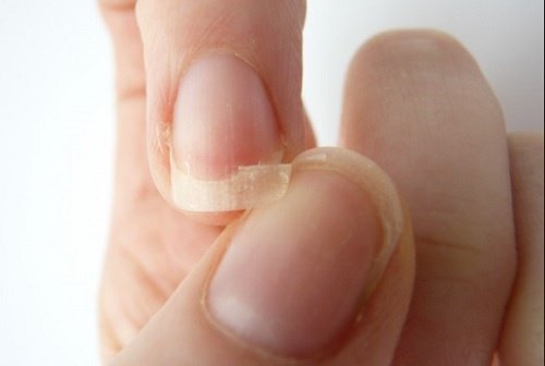 łamiący się paznokieć - sposoby na paznokcie