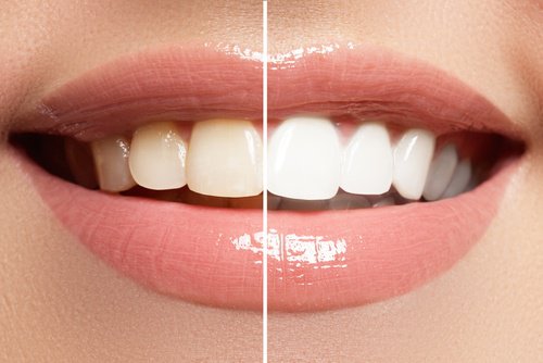 wybielanie zębów - przed i po