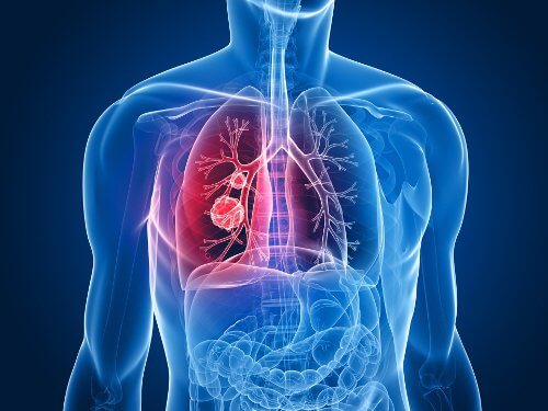 Rak płuc - 9 najczęstszych objawów
