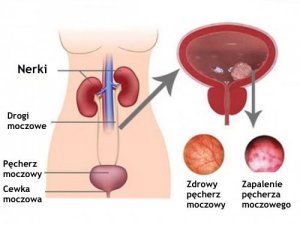 Naturalne sposoby na zapalenie pęcherza
