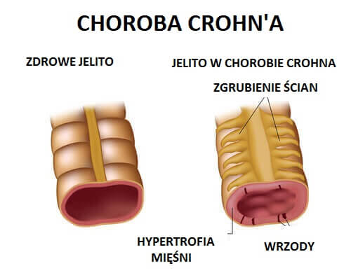 Diagnoza choroby Crohna - schemat jelita